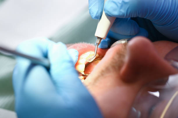 Best Chipped Tooth Repair Near Me  in Charenton, LA