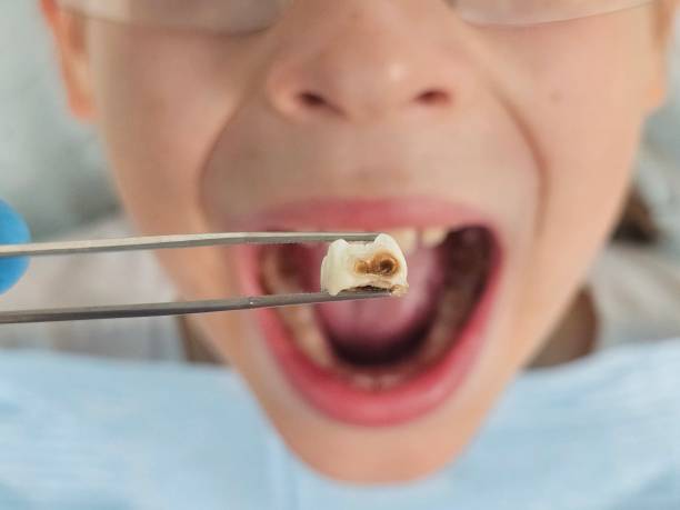 Best Root Canal Emergency Dentist  in Charenton, LA
